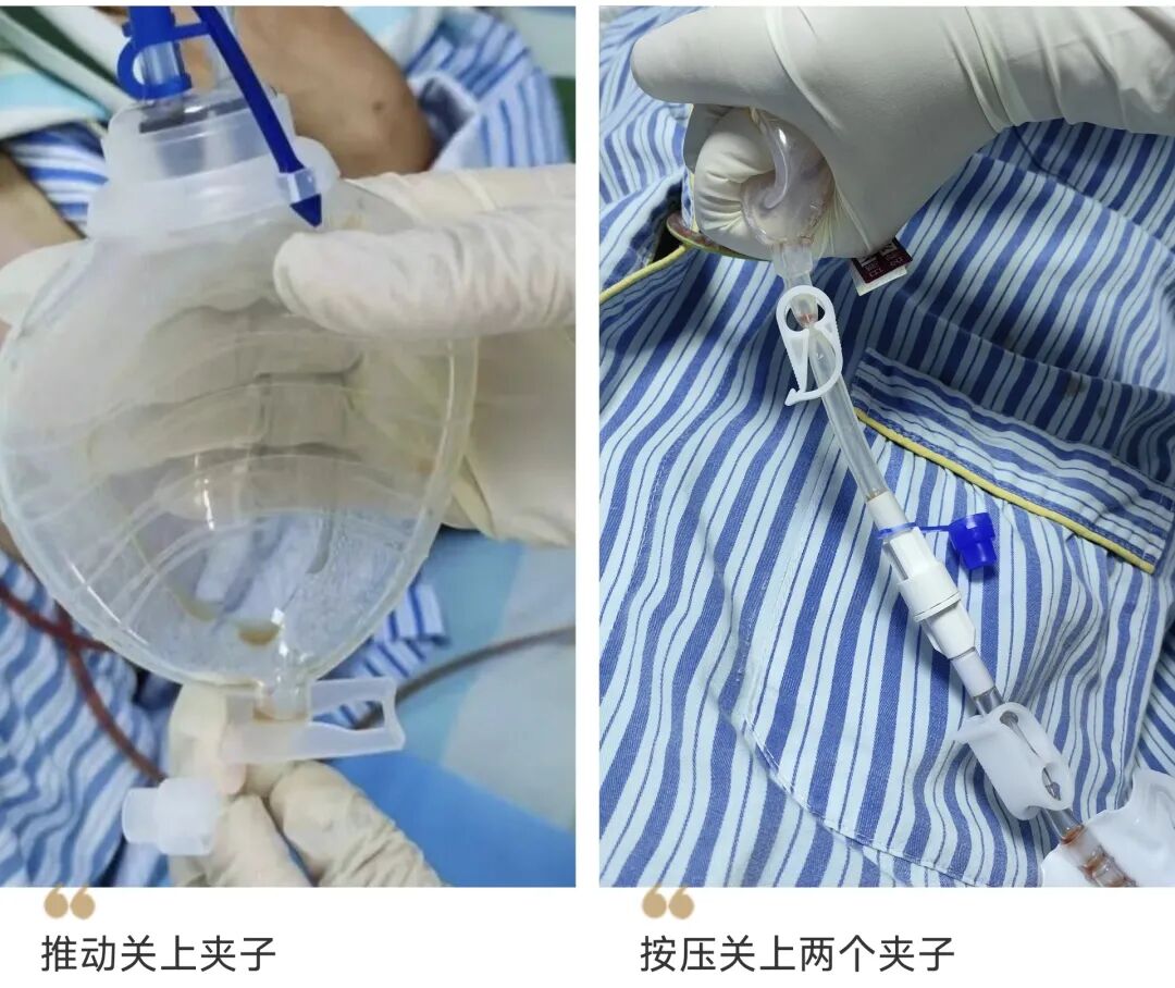 伤口引流袋怎么用保“管”学会——乳腺癌术后带管居家护理_https://www.jmylbn.com_新闻资讯_第14张