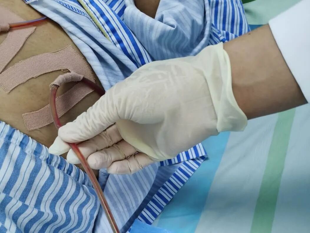 伤口引流袋怎么用保“管”学会——乳腺癌术后带管居家护理_https://www.jmylbn.com_新闻资讯_第10张