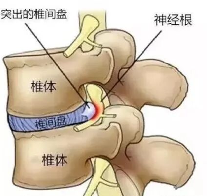 常见腰痛原因 健康科普 广西骨伤医院