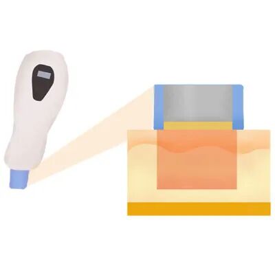 多极射频是什么热玛吉的单极射频和多极射频的区别_https://www.jmylbn.com_新闻资讯_第5张