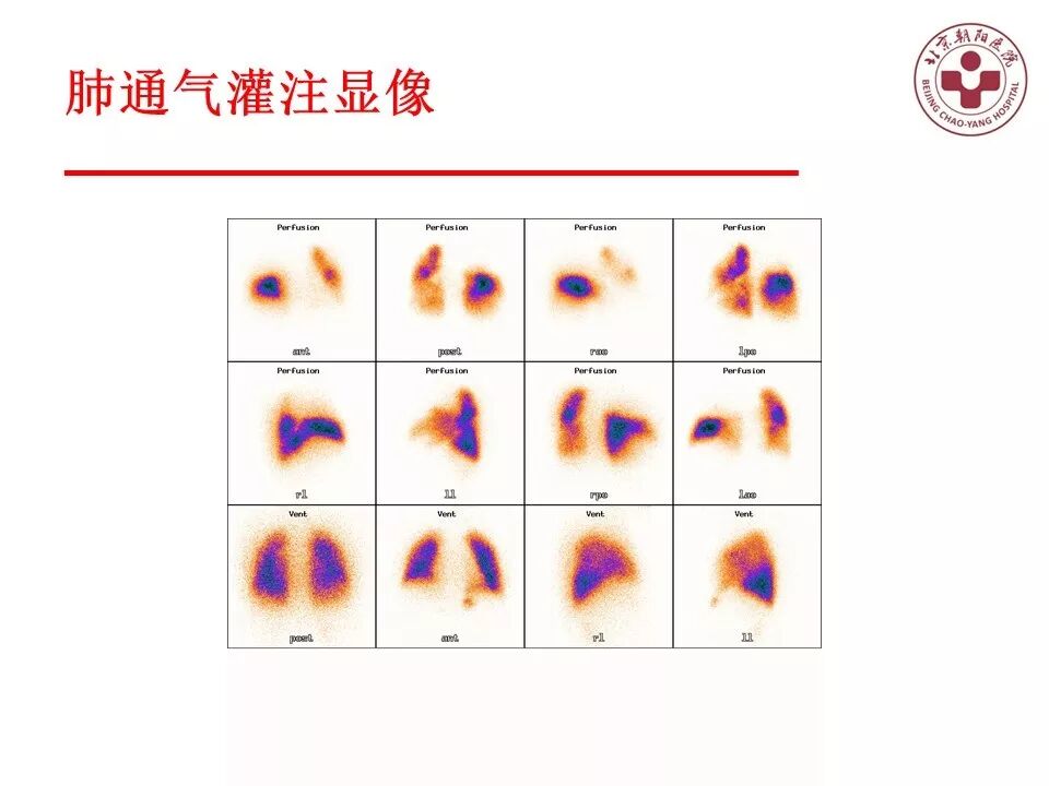 d-spect怎么检查【核汇园】20期：王铁教授 ｜《肺通气-灌注SPECT／CT显像评价肺动脉栓塞》_https://www.jmylbn.com_新闻资讯_第33张