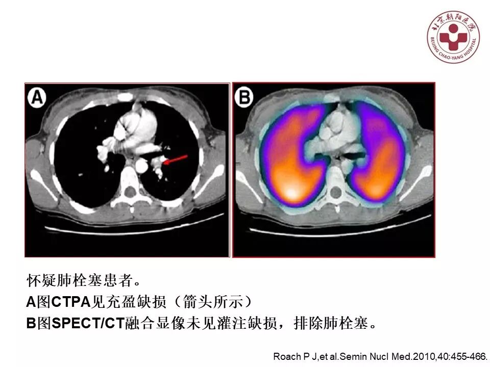 d-spect怎么检查【核汇园】20期：王铁教授 ｜《肺通气-灌注SPECT／CT显像评价肺动脉栓塞》_https://www.jmylbn.com_新闻资讯_第43张
