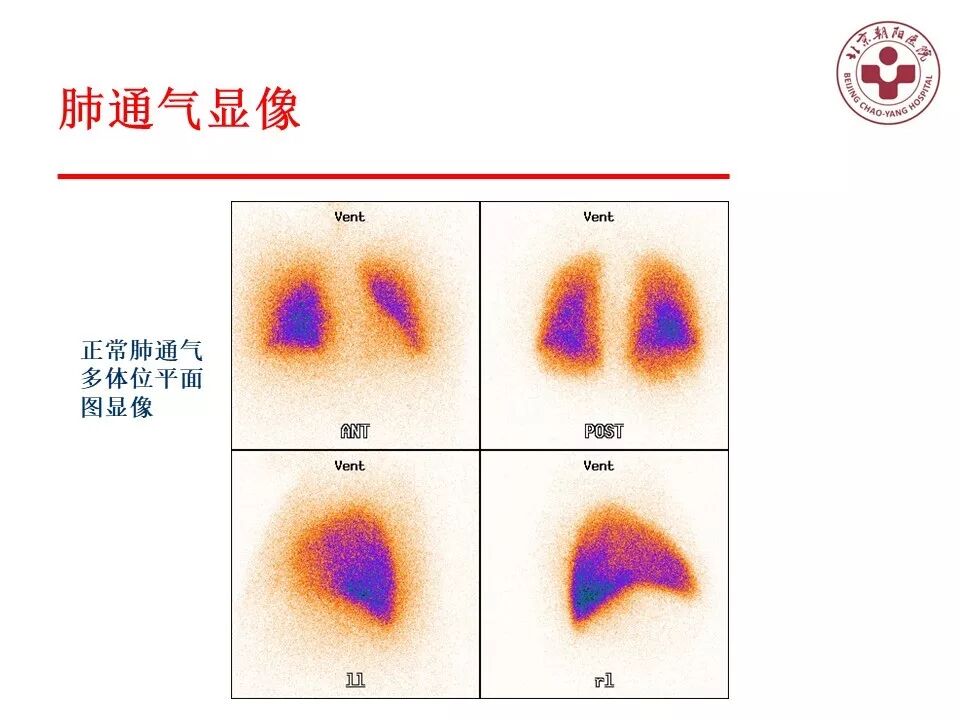 d-spect怎么检查【核汇园】20期：王铁教授 ｜《肺通气-灌注SPECT／CT显像评价肺动脉栓塞》_https://www.jmylbn.com_新闻资讯_第17张