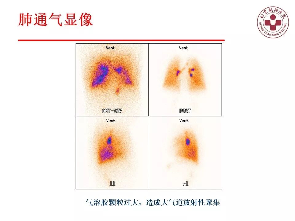 d-spect怎么检查【核汇园】20期：王铁教授 ｜《肺通气-灌注SPECT／CT显像评价肺动脉栓塞》_https://www.jmylbn.com_新闻资讯_第19张