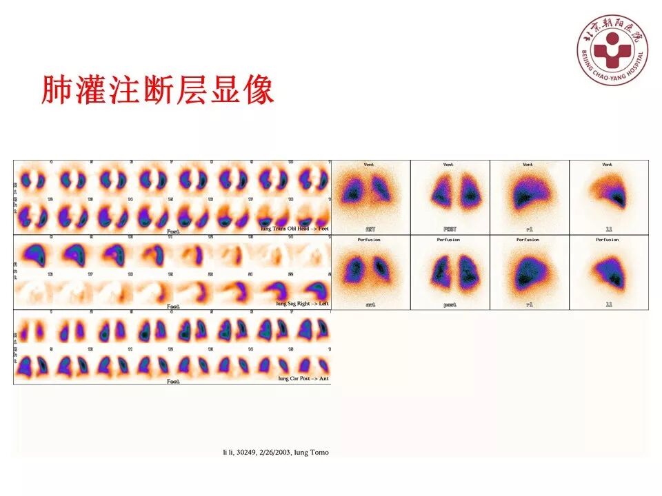 d-spect怎么检查【核汇园】20期：王铁教授 ｜《肺通气-灌注SPECT／CT显像评价肺动脉栓塞》_https://www.jmylbn.com_新闻资讯_第39张