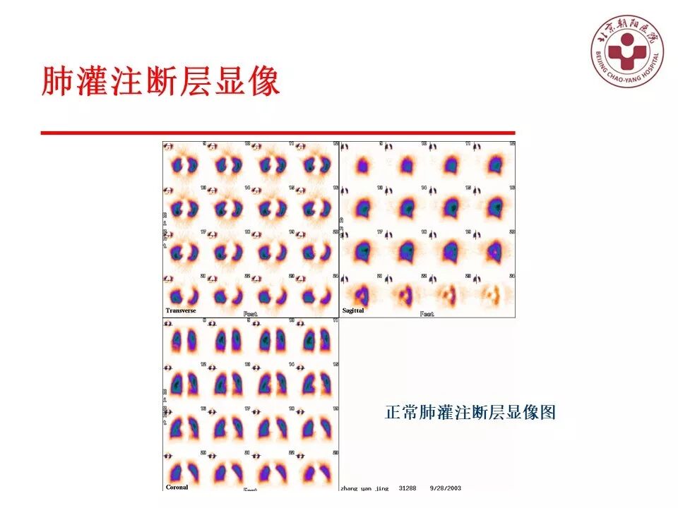 d-spect怎么检查【核汇园】20期：王铁教授 ｜《肺通气-灌注SPECT／CT显像评价肺动脉栓塞》_https://www.jmylbn.com_新闻资讯_第35张