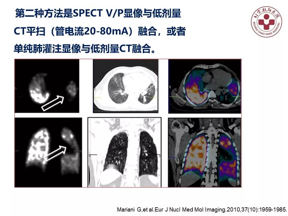 d-spect怎么检查【核汇园】20期：王铁教授 ｜《肺通气-灌注SPECT／CT显像评价肺动脉栓塞》_https://www.jmylbn.com_新闻资讯_第44张