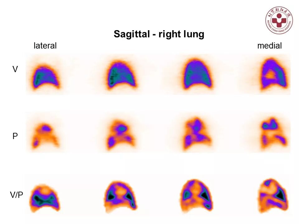 d-spect怎么检查【核汇园】20期：王铁教授 ｜《肺通气-灌注SPECT／CT显像评价肺动脉栓塞》_https://www.jmylbn.com_新闻资讯_第53张