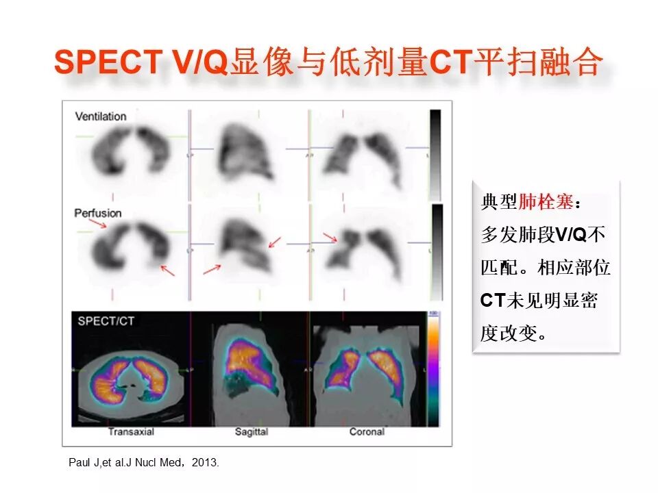 d-spect怎么检查【核汇园】20期：王铁教授 ｜《肺通气-灌注SPECT／CT显像评价肺动脉栓塞》_https://www.jmylbn.com_新闻资讯_第46张