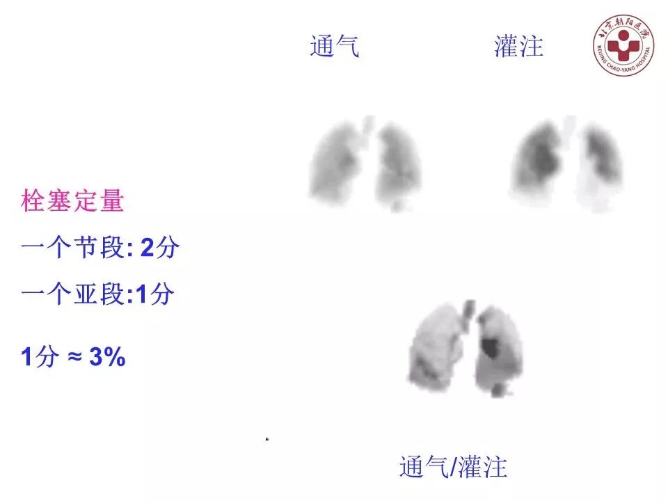 d-spect怎么检查【核汇园】20期：王铁教授 ｜《肺通气-灌注SPECT／CT显像评价肺动脉栓塞》_https://www.jmylbn.com_新闻资讯_第55张