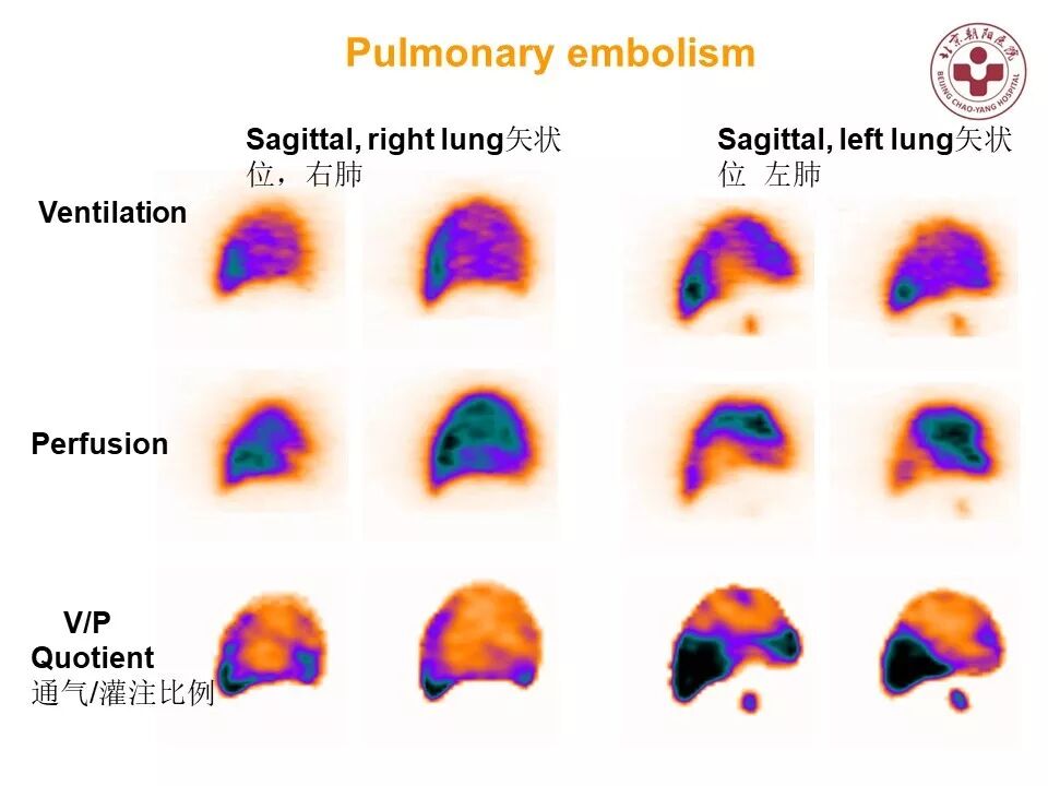 d-spect怎么检查【核汇园】20期：王铁教授 ｜《肺通气-灌注SPECT／CT显像评价肺动脉栓塞》_https://www.jmylbn.com_新闻资讯_第54张