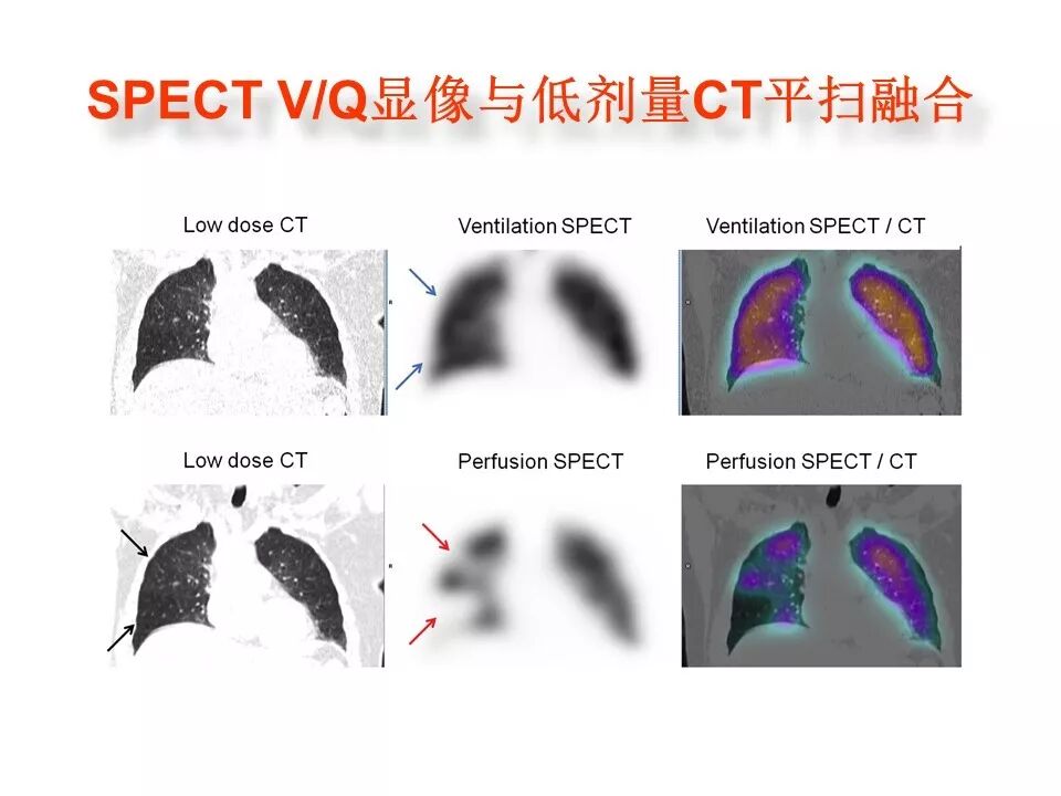 d-spect怎么检查【核汇园】20期：王铁教授 ｜《肺通气-灌注SPECT／CT显像评价肺动脉栓塞》_https://www.jmylbn.com_新闻资讯_第45张