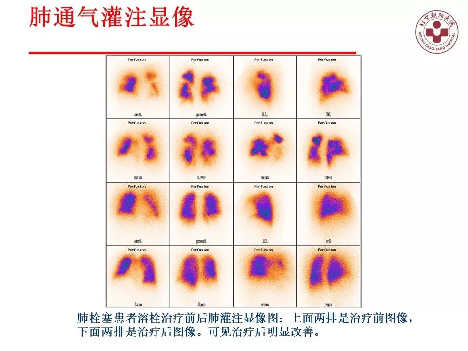 d-spect怎么检查【核汇园】20期：王铁教授 ｜《肺通气-灌注SPECT／CT显像评价肺动脉栓塞》_https://www.jmylbn.com_新闻资讯_第58张