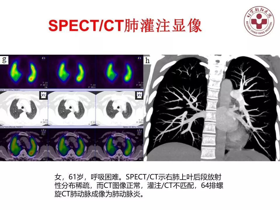 d-spect怎么检查【核汇园】20期：王铁教授 ｜《肺通气-灌注SPECT／CT显像评价肺动脉栓塞》_https://www.jmylbn.com_新闻资讯_第65张