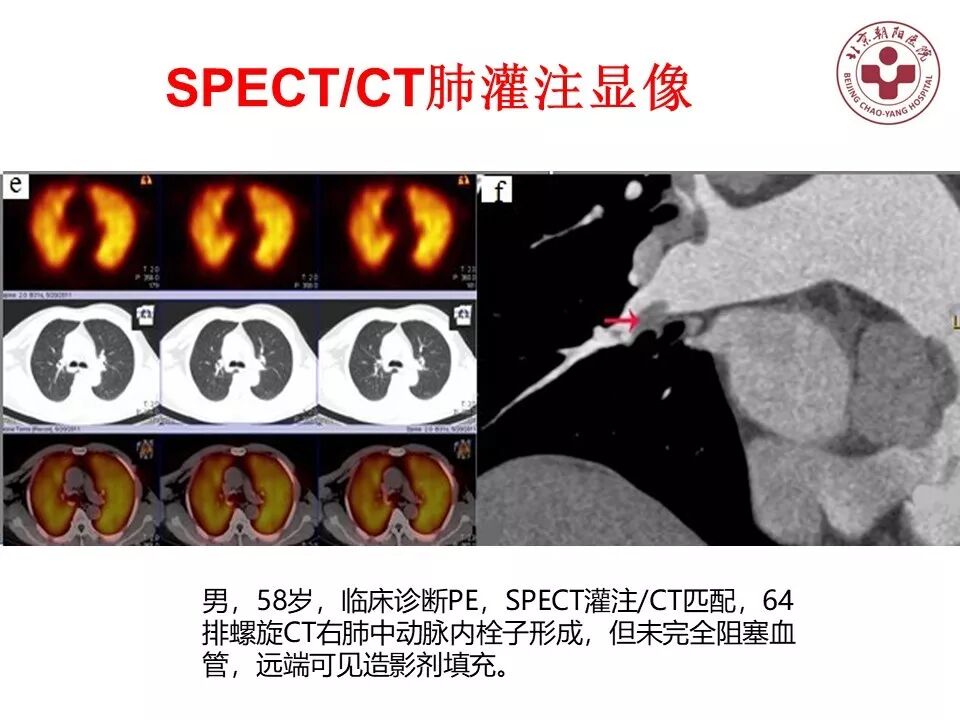 d-spect怎么检查【核汇园】20期：王铁教授 ｜《肺通气-灌注SPECT／CT显像评价肺动脉栓塞》_https://www.jmylbn.com_新闻资讯_第48张