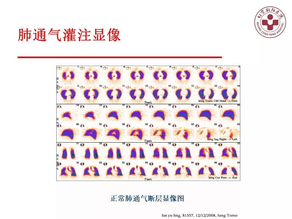 d-spect怎么检查【核汇园】20期：王铁教授 ｜《肺通气-灌注SPECT／CT显像评价肺动脉栓塞》_https://www.jmylbn.com_新闻资讯_第36张