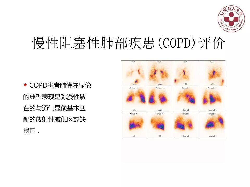 d-spect怎么检查【核汇园】20期：王铁教授 ｜《肺通气-灌注SPECT／CT显像评价肺动脉栓塞》_https://www.jmylbn.com_新闻资讯_第61张
