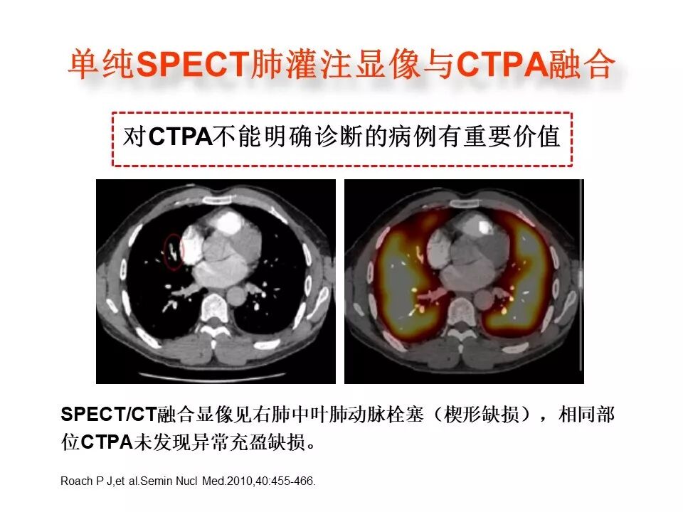 d-spect怎么检查【核汇园】20期：王铁教授 ｜《肺通气-灌注SPECT／CT显像评价肺动脉栓塞》_https://www.jmylbn.com_新闻资讯_第42张