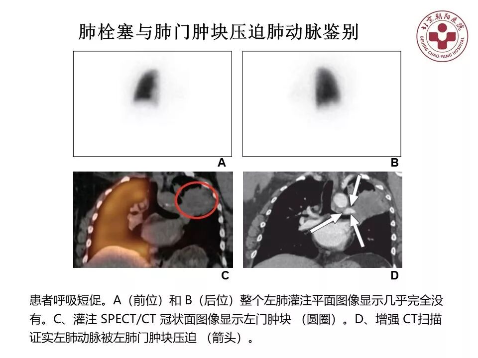 d-spect怎么检查【核汇园】20期：王铁教授 ｜《肺通气-灌注SPECT／CT显像评价肺动脉栓塞》_https://www.jmylbn.com_新闻资讯_第67张