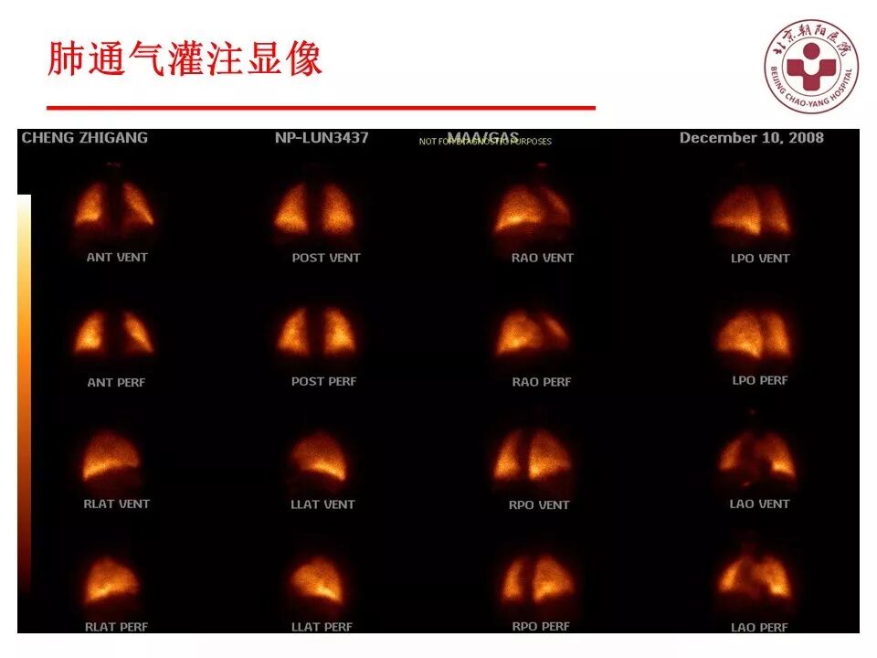 d-spect怎么检查【核汇园】20期：王铁教授 ｜《肺通气-灌注SPECT／CT显像评价肺动脉栓塞》_https://www.jmylbn.com_新闻资讯_第22张