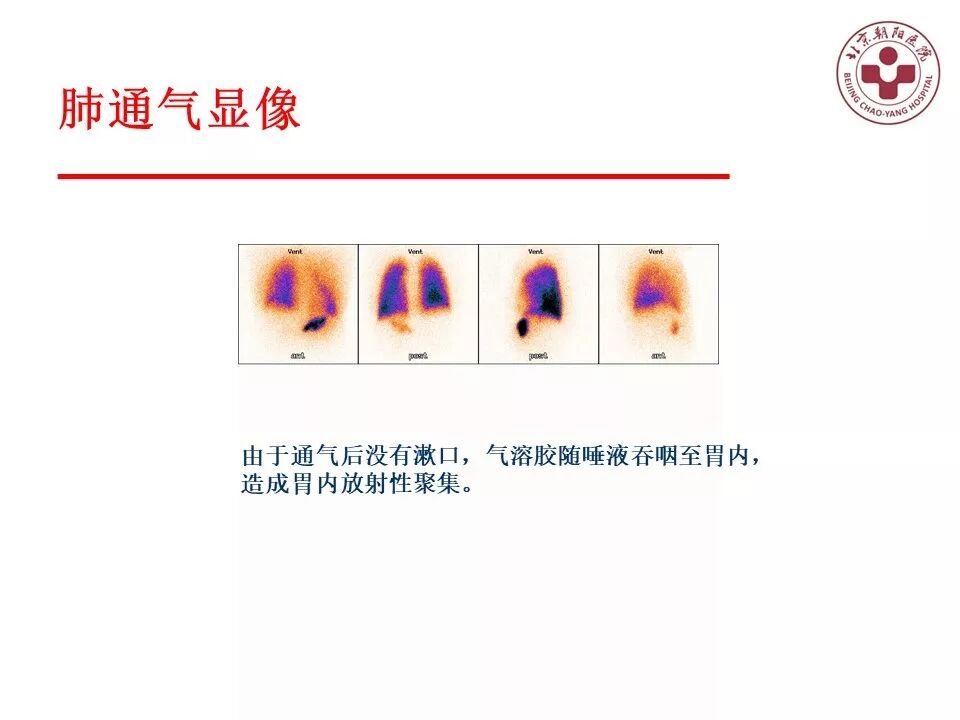 d-spect怎么检查【核汇园】20期：王铁教授 ｜《肺通气-灌注SPECT／CT显像评价肺动脉栓塞》_https://www.jmylbn.com_新闻资讯_第20张