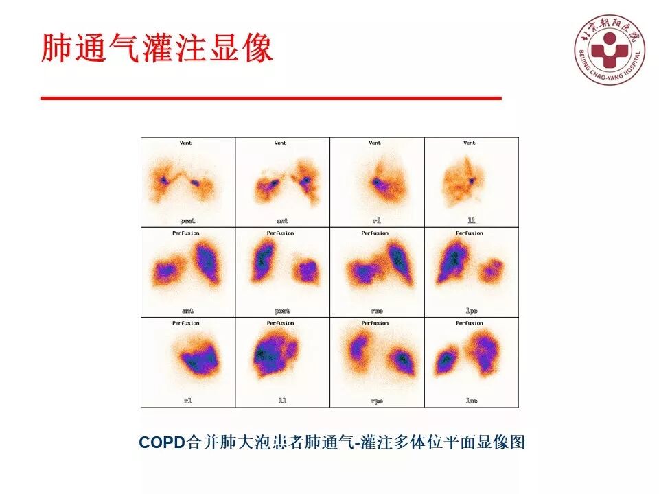 d-spect怎么检查【核汇园】20期：王铁教授 ｜《肺通气-灌注SPECT／CT显像评价肺动脉栓塞》_https://www.jmylbn.com_新闻资讯_第64张