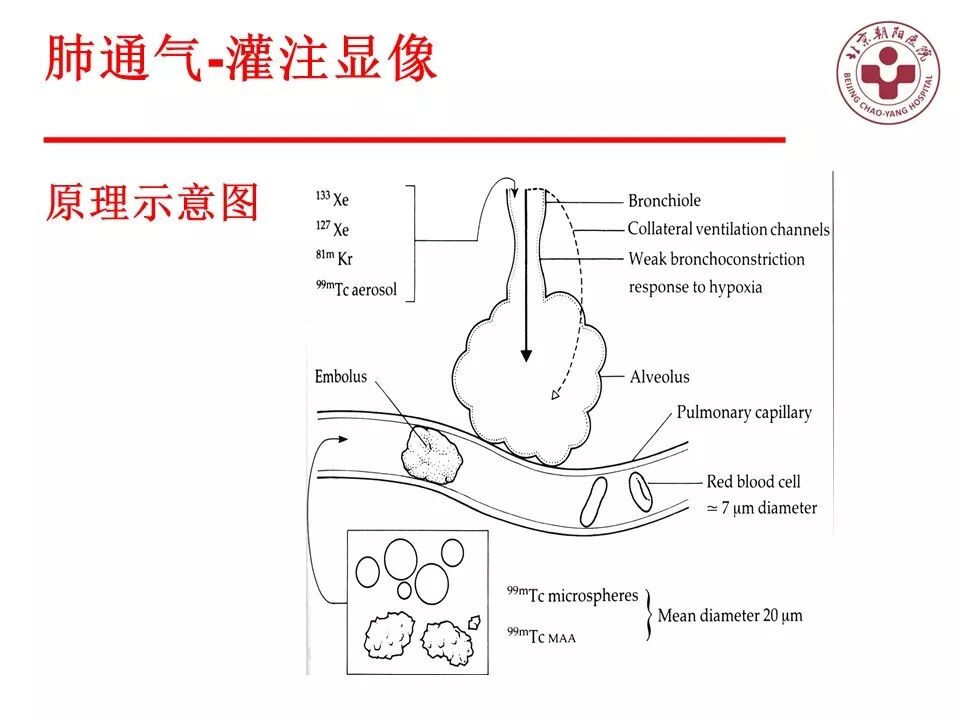 d-spect怎么检查【核汇园】20期：王铁教授 ｜《肺通气-灌注SPECT／CT显像评价肺动脉栓塞》_https://www.jmylbn.com_新闻资讯_第31张