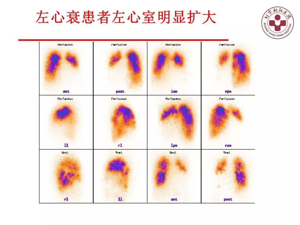 d-spect怎么检查【核汇园】20期：王铁教授 ｜《肺通气-灌注SPECT／CT显像评价肺动脉栓塞》_https://www.jmylbn.com_新闻资讯_第68张