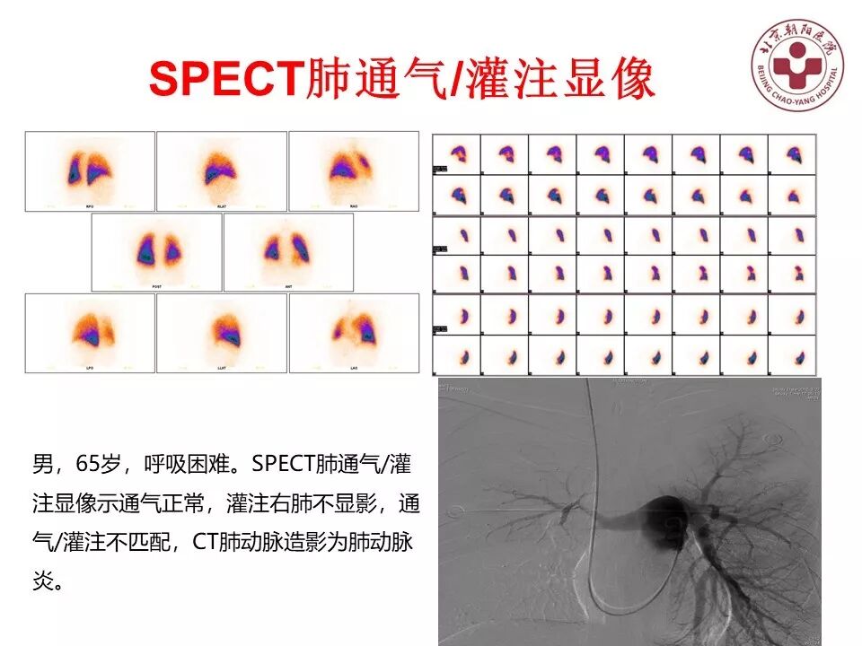 d-spect怎么检查【核汇园】20期：王铁教授 ｜《肺通气-灌注SPECT／CT显像评价肺动脉栓塞》_https://www.jmylbn.com_新闻资讯_第66张