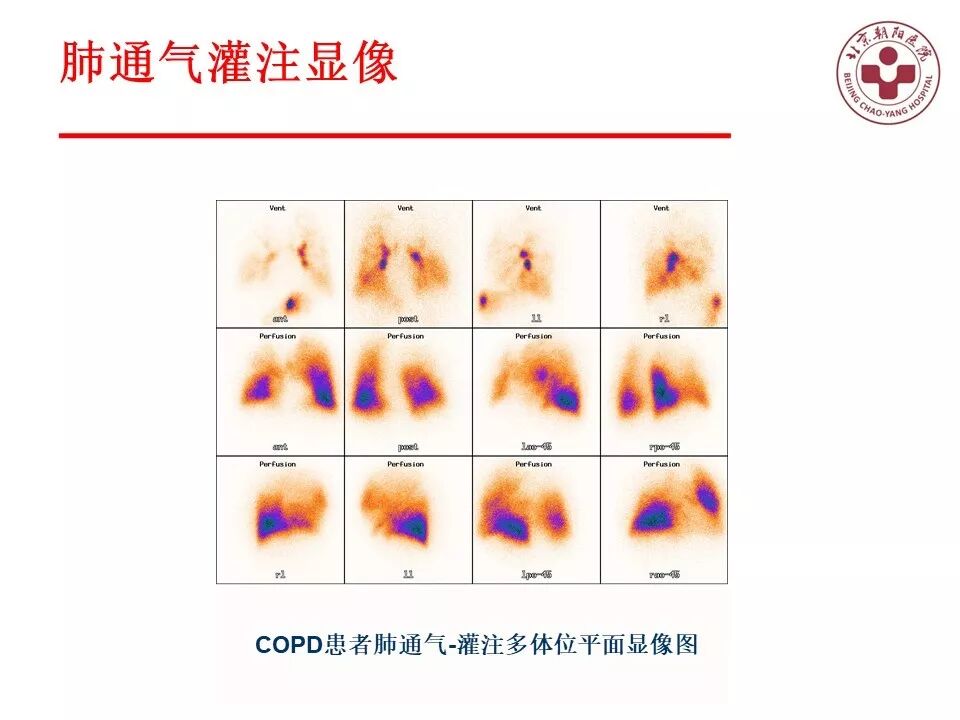 d-spect怎么检查【核汇园】20期：王铁教授 ｜《肺通气-灌注SPECT／CT显像评价肺动脉栓塞》_https://www.jmylbn.com_新闻资讯_第63张