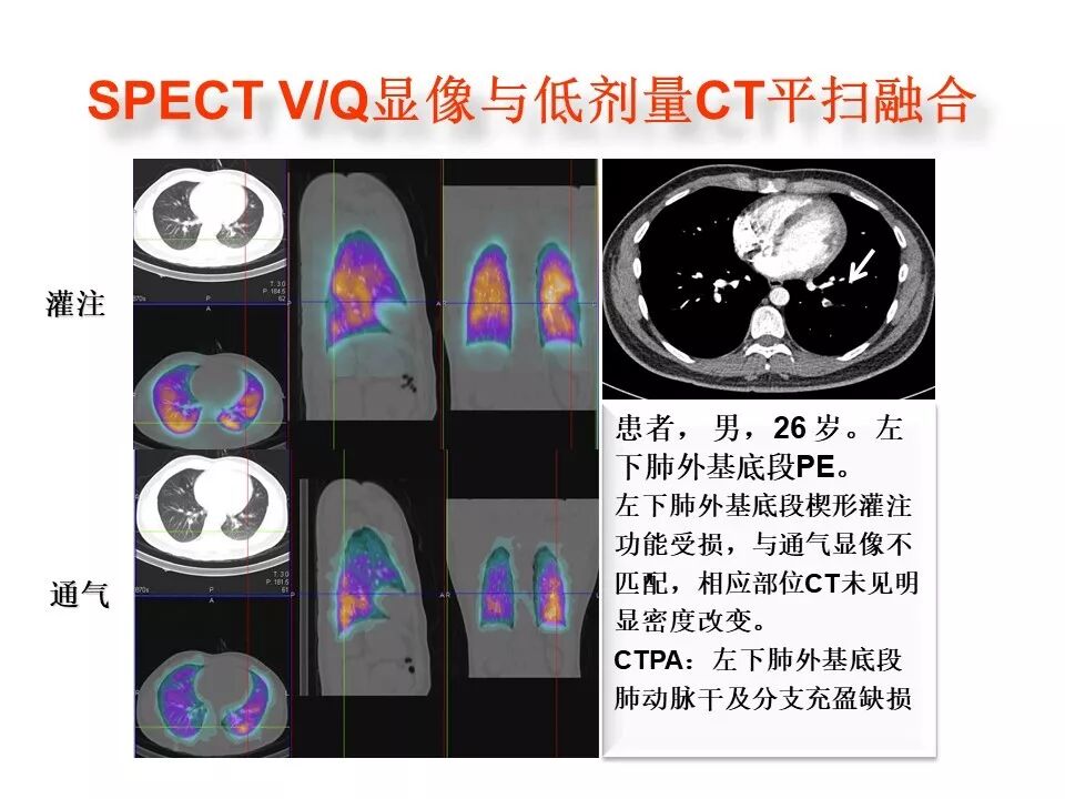 d-spect怎么检查【核汇园】20期：王铁教授 ｜《肺通气-灌注SPECT／CT显像评价肺动脉栓塞》_https://www.jmylbn.com_新闻资讯_第47张