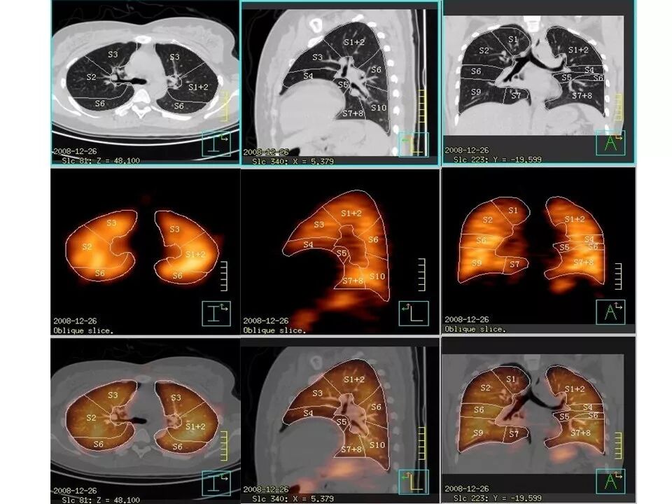 d-spect怎么检查【核汇园】20期：王铁教授 ｜《肺通气-灌注SPECT／CT显像评价肺动脉栓塞》_https://www.jmylbn.com_新闻资讯_第37张