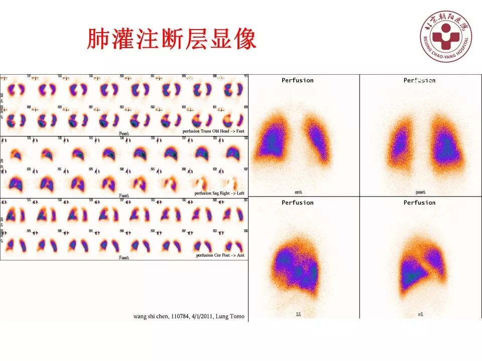 d-spect怎么检查【核汇园】20期：王铁教授 ｜《肺通气-灌注SPECT／CT显像评价肺动脉栓塞》_https://www.jmylbn.com_新闻资讯_第40张