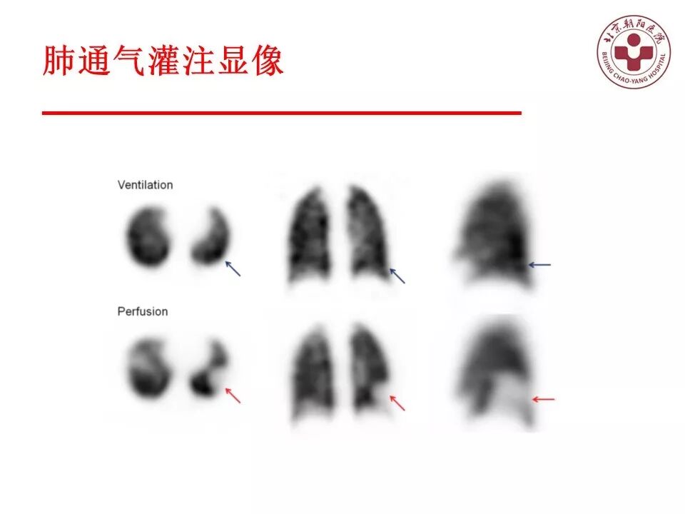 d-spect怎么检查【核汇园】20期：王铁教授 ｜《肺通气-灌注SPECT／CT显像评价肺动脉栓塞》_https://www.jmylbn.com_新闻资讯_第32张
