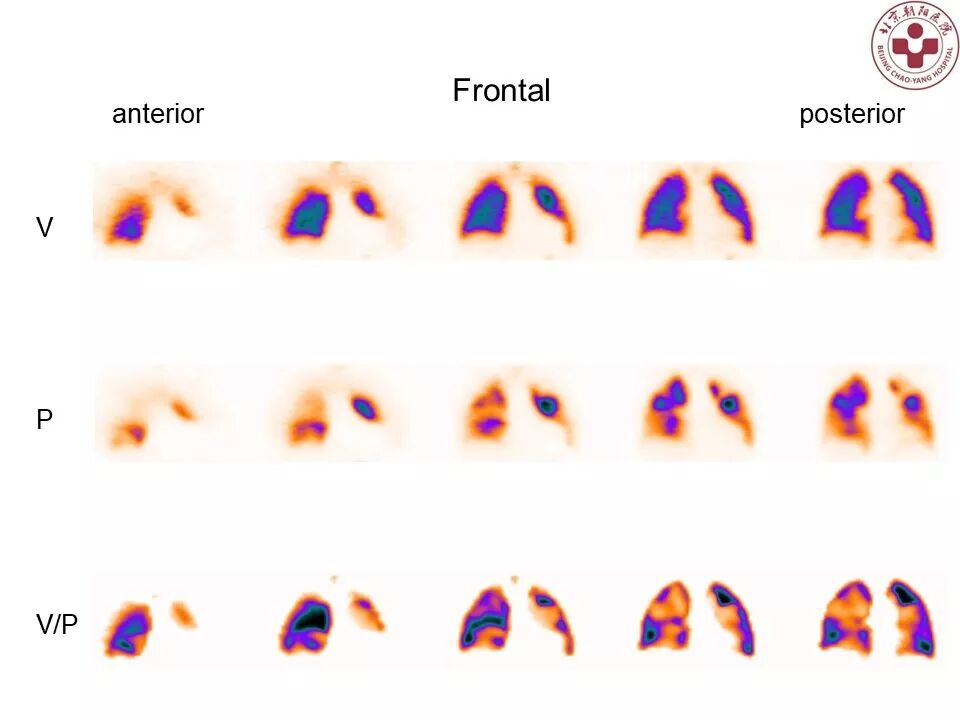 d-spect怎么检查【核汇园】20期：王铁教授 ｜《肺通气-灌注SPECT／CT显像评价肺动脉栓塞》_https://www.jmylbn.com_新闻资讯_第52张
