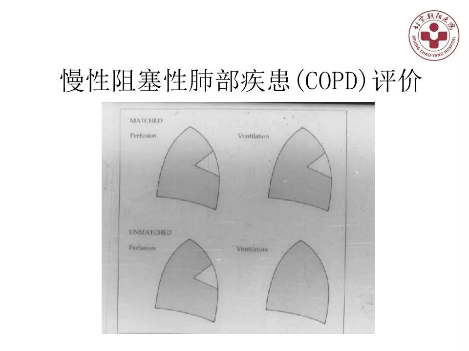 d-spect怎么检查【核汇园】20期：王铁教授 ｜《肺通气-灌注SPECT／CT显像评价肺动脉栓塞》_https://www.jmylbn.com_新闻资讯_第60张