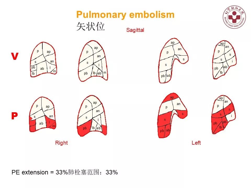 d-spect怎么检查【核汇园】20期：王铁教授 ｜《肺通气-灌注SPECT／CT显像评价肺动脉栓塞》_https://www.jmylbn.com_新闻资讯_第56张