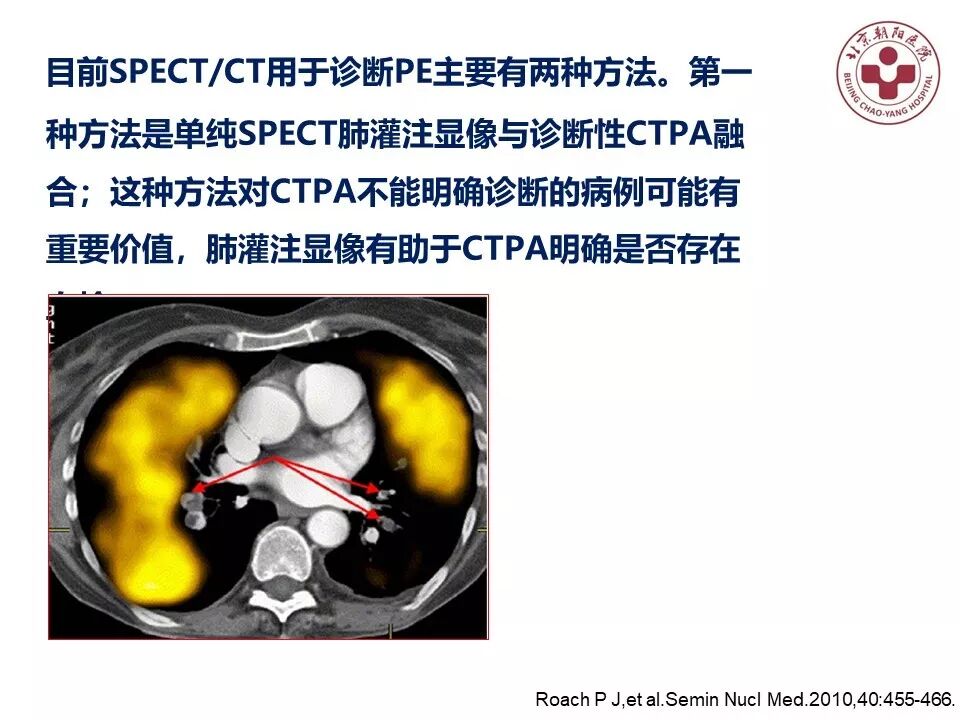 d-spect怎么检查【核汇园】20期：王铁教授 ｜《肺通气-灌注SPECT／CT显像评价肺动脉栓塞》_https://www.jmylbn.com_新闻资讯_第41张