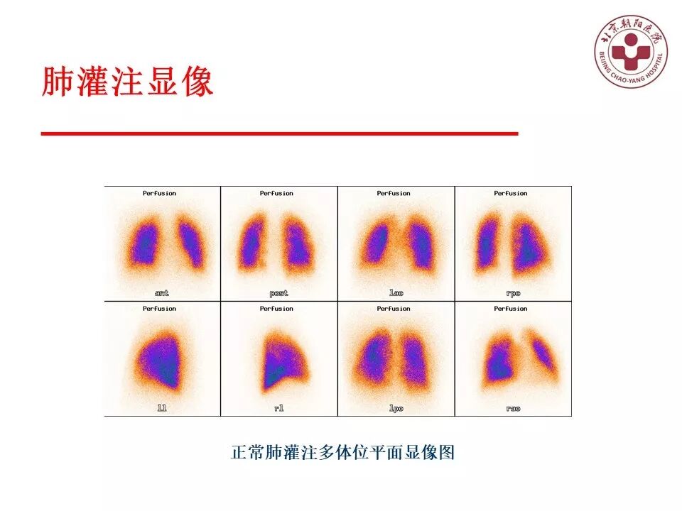 d-spect怎么检查【核汇园】20期：王铁教授 ｜《肺通气-灌注SPECT／CT显像评价肺动脉栓塞》_https://www.jmylbn.com_新闻资讯_第15张