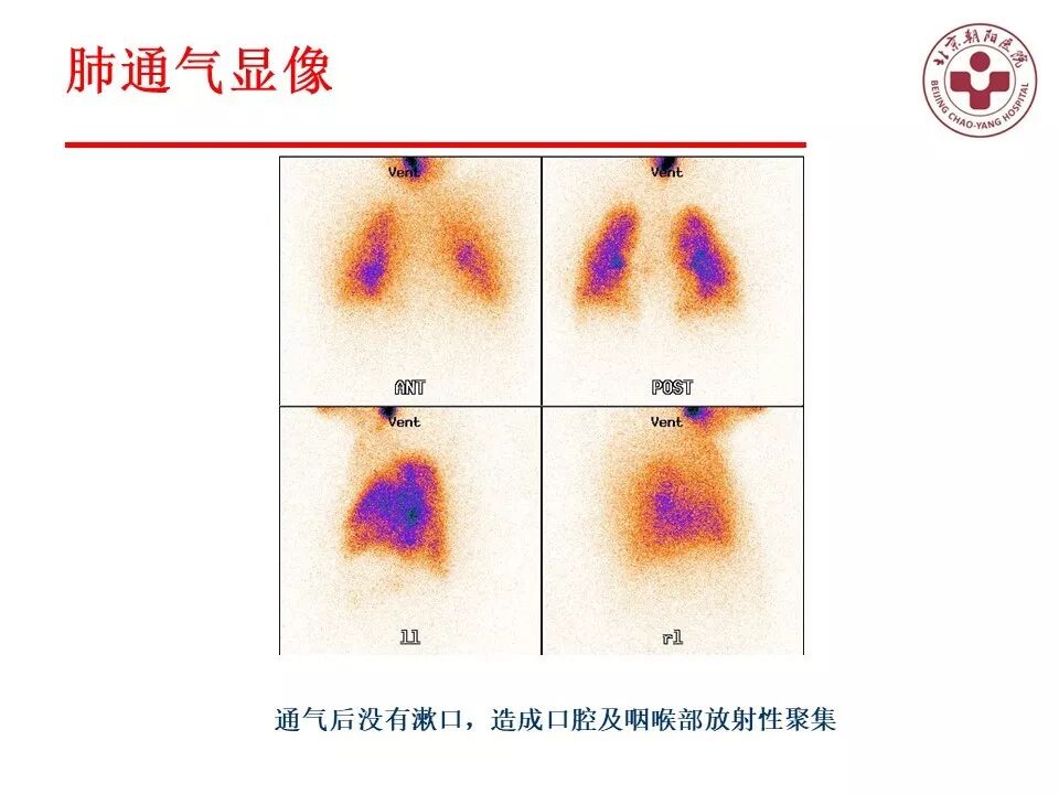 d-spect怎么检查【核汇园】20期：王铁教授 ｜《肺通气-灌注SPECT／CT显像评价肺动脉栓塞》_https://www.jmylbn.com_新闻资讯_第18张