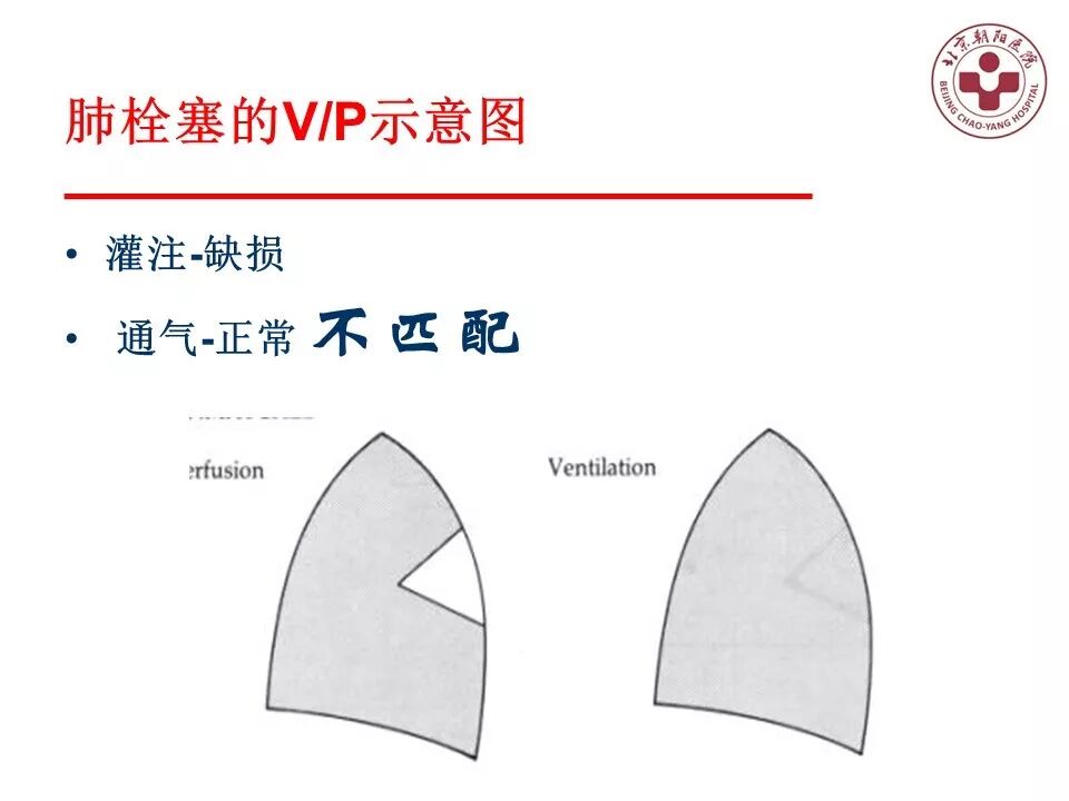 d-spect怎么检查【核汇园】20期：王铁教授 ｜《肺通气-灌注SPECT／CT显像评价肺动脉栓塞》_https://www.jmylbn.com_新闻资讯_第30张