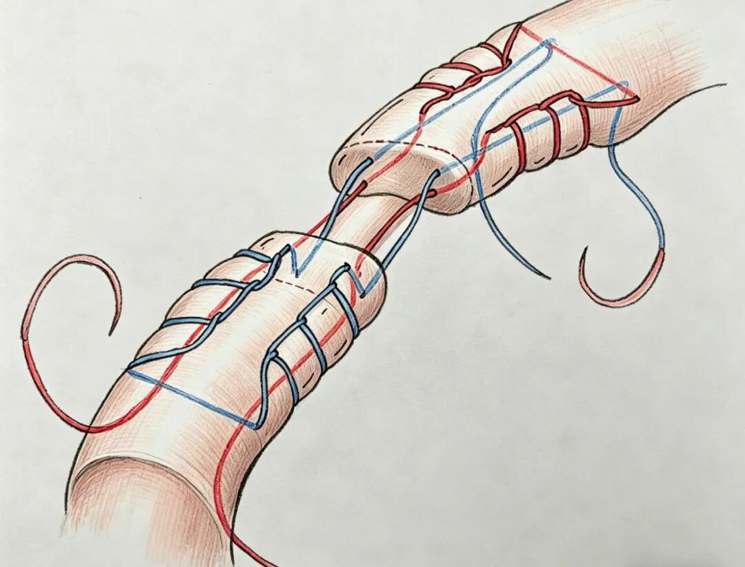 【手术技巧】急性跟腱修复之吊桥技术
