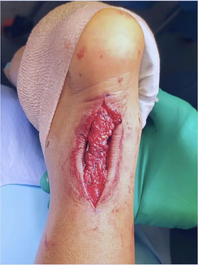 【手术技巧】急性跟腱修复之吊桥技术