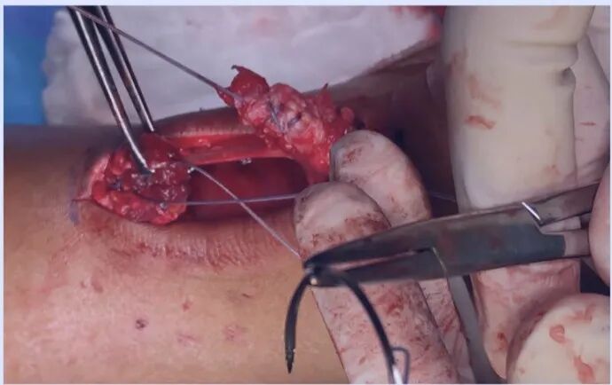 【手术技巧】急性跟腱修复之吊桥技术