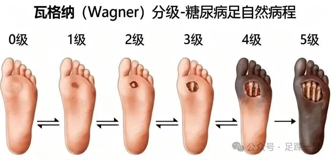 【指南与共识】骨水泥在糖尿病创面治疗中的应用专家共识2026