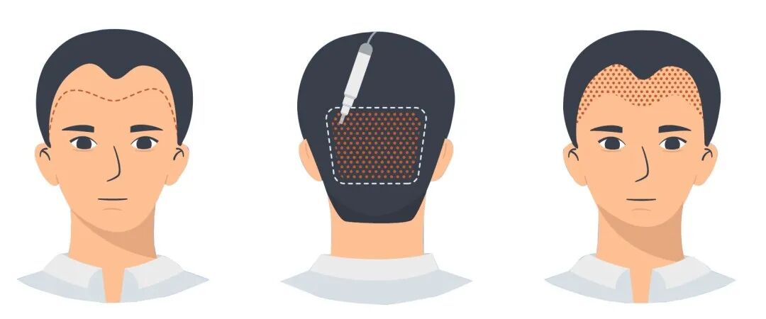FUE怎么提取毛囊自测一下，你是否脱发？FUE 和 FUT植发技术各有利弊，看完你会选择哪一种？_https://www.jmylbn.com_新闻资讯_第4张