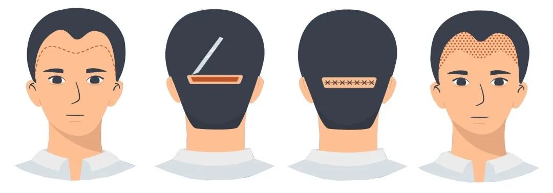 FUE怎么提取毛囊自测一下，你是否脱发？FUE 和 FUT植发技术各有利弊，看完你会选择哪一种？_https://www.jmylbn.com_新闻资讯_第3张