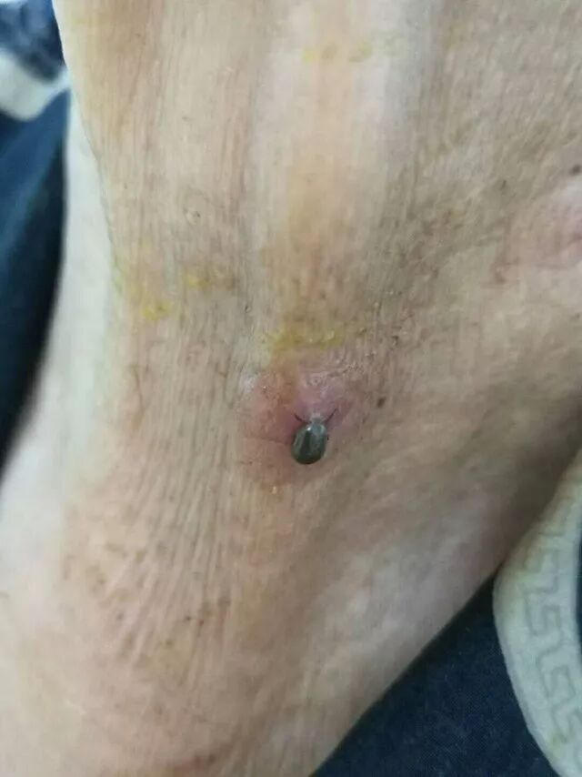 蜱虫夺命丨济南历城一老人被蜱虫叮咬后身亡专家提醒夏季高发别让蜱虫