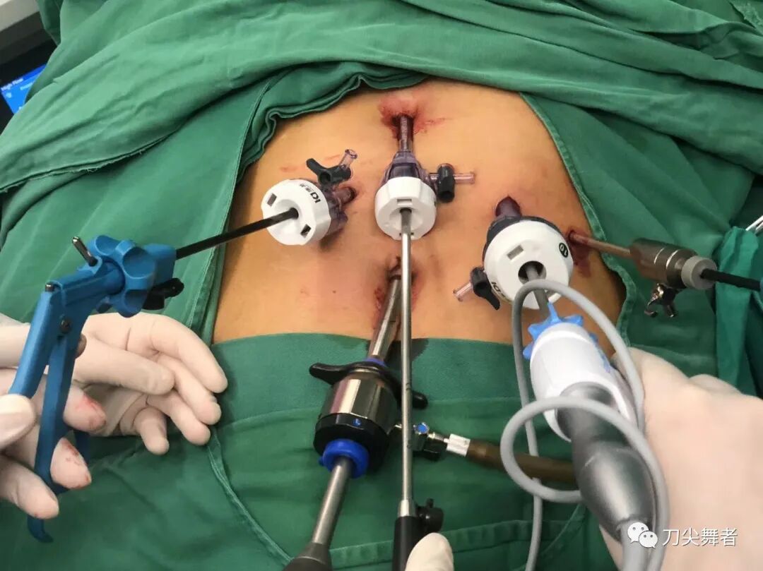 肝胆外科用哪些耗材一文盘点！普外科手术配合（肝、胆、胰）_https://www.jmylbn.com_新闻资讯_第2张