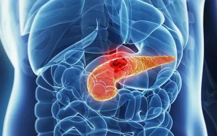【注意】这些症状可能是胰腺癌发出的求救信号！